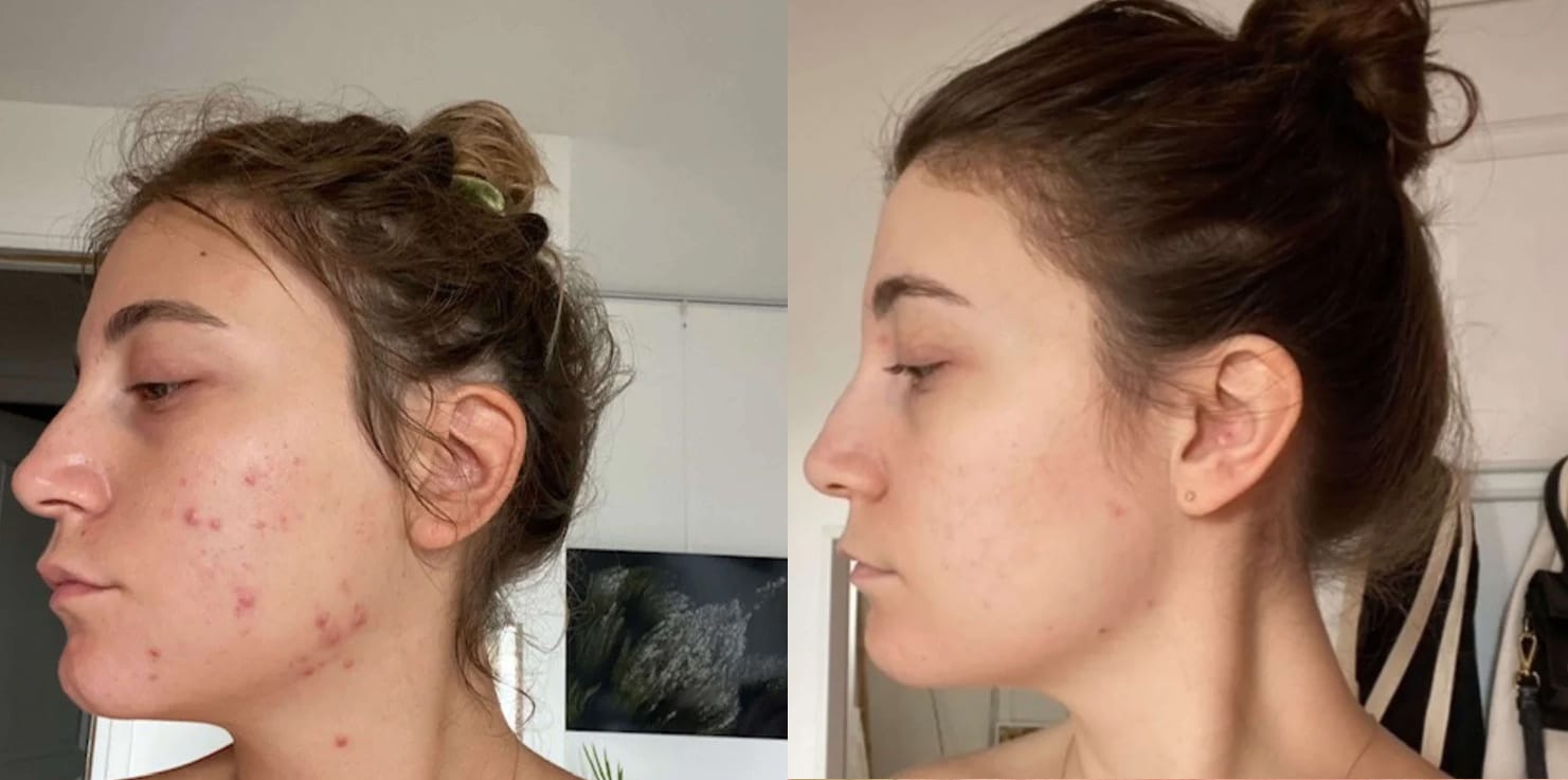 SkinOut anti acne photos avant apres