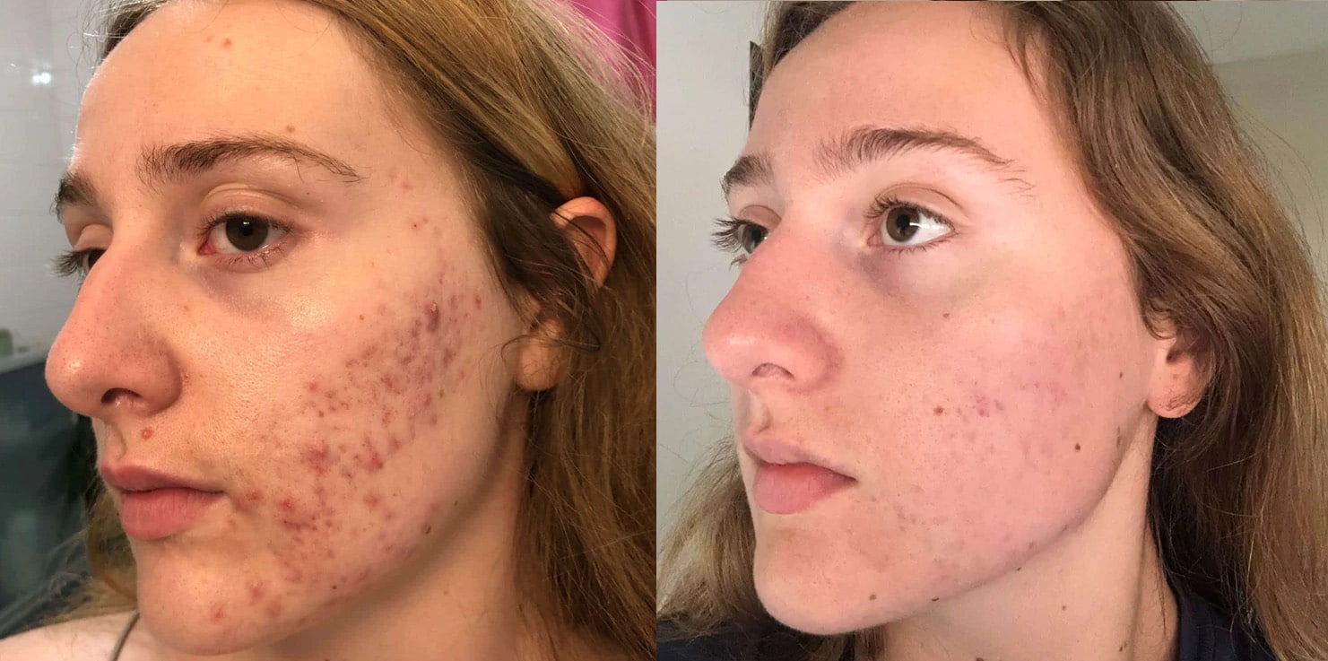 SkinOut contre acne photos avant apres