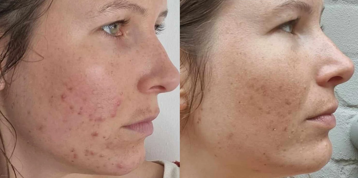 SkinOut temoignage Johanna avant apres